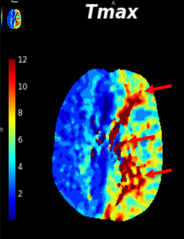 Identifying the Cause of Acute Left-Sided Visual Loss: A Clinical Dilemma.