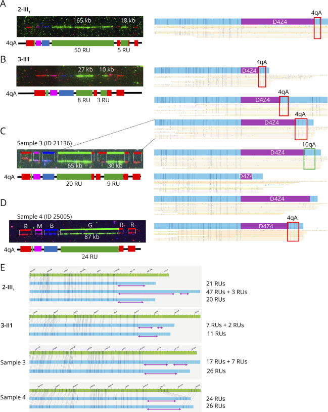 Complex 4q35 and 10q26 Rearrangements: A Challenge for Molecular Diagnosis of Patients With Facioscapulohumeral Dystrophy.