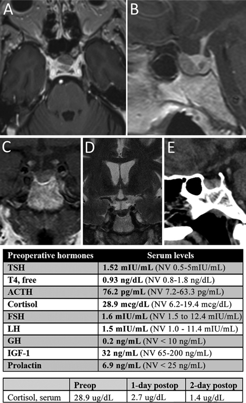 Synchronous Posterior and Anterior Pituitary Tumors: A Case Report of a Hypothetic Paracrine Relationship.