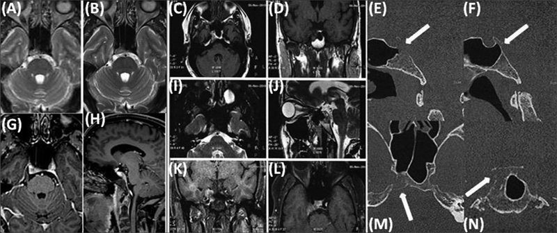 Sellar-Parasellar and Petrous Bone Metastasis from Differentiated Thyroid Carcinoma: Imaging Characteristics and Follow-Up Profile Post Radioiodine Therapy.