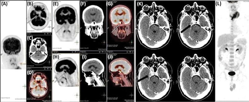 Sellar-Parasellar and Petrous Bone Metastasis from Differentiated Thyroid Carcinoma: Imaging Characteristics and Follow-Up Profile Post Radioiodine Therapy.