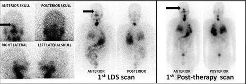 Sellar-Parasellar and Petrous Bone Metastasis from Differentiated Thyroid Carcinoma: Imaging Characteristics and Follow-Up Profile Post Radioiodine Therapy.