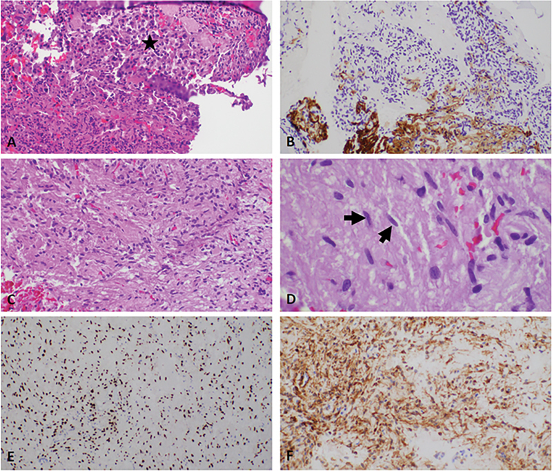 Synchronous Posterior and Anterior Pituitary Tumors: A Case Report of a Hypothetic Paracrine Relationship.