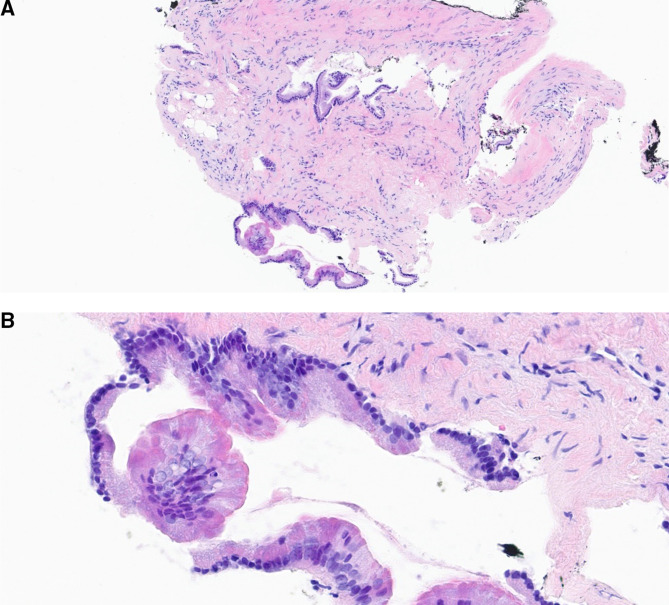 EUS-guided through the needle microbiopsy: a useful adjunct in the investigation of pancreatic cystic lesions.