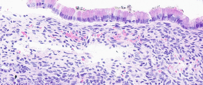 EUS-guided through the needle microbiopsy: a useful adjunct in the investigation of pancreatic cystic lesions.