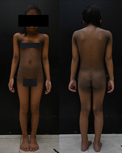 Crouzon syndrome with acanthosis nigricans: a case report and literature review.