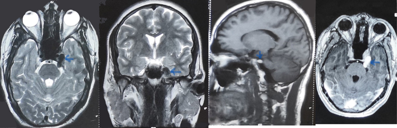 A Case of Malignant Melanotic Schwannoma of the Trigeminal Nerve: A Case Report and Review of Literature.