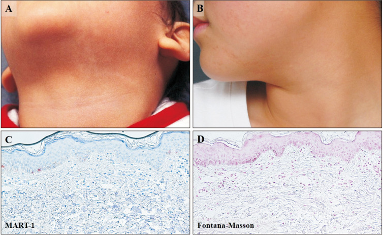 Natural History of Nevus Depigmentosus: A Long-term Follow-up Study of 102 Cases.