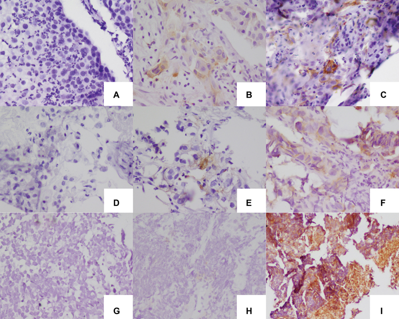 Expression of PD-L1 in Lung Carcinoma and Its Correlation with Histopathological Grade, Stage, and Survival of Patients.