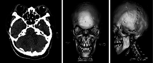 Crouzon syndrome with acanthosis nigricans: a case report and literature review.