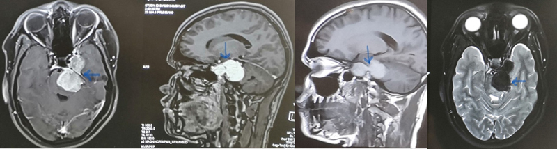 A Case of Malignant Melanotic Schwannoma of the Trigeminal Nerve: A Case Report and Review of Literature.