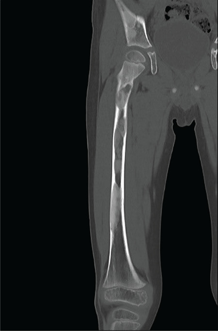 Polyostotic Fibrous Dysplasia in a Six-year-Old Boy.