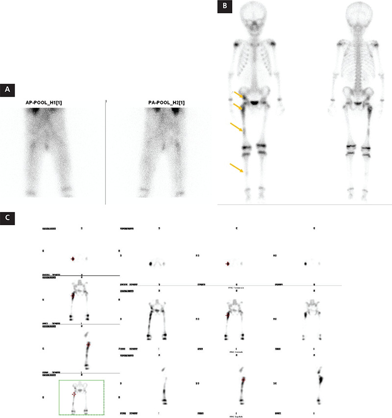 Polyostotic Fibrous Dysplasia in a Six-year-Old Boy.