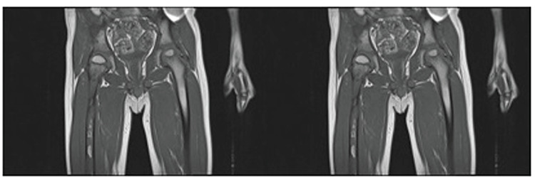 Polyostotic Fibrous Dysplasia in a Six-year-Old Boy.