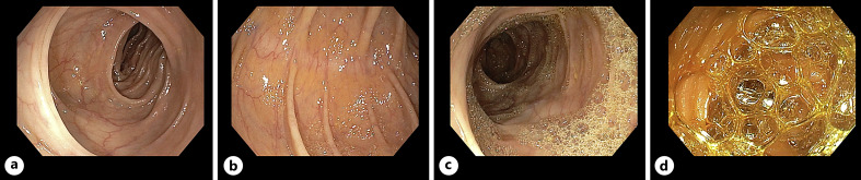 The Effect of Oral Simethicone in a Bowel Preparation in a Colorectal Cancer Screening Colonoscopy Setting: A Randomized Controlled Trial.