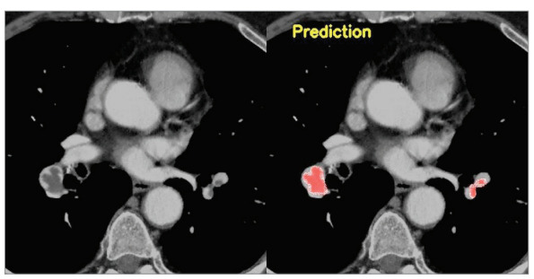 [Segmentation of acute pulmonary embolism in computed tomography pulmonary angiography using the deep learning method].