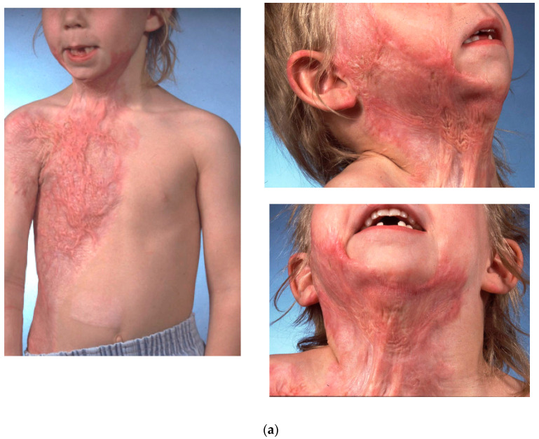 Free Tissue Transfer in the Reconstruction of Neck Contractures after Burn Injury: A Case Series.