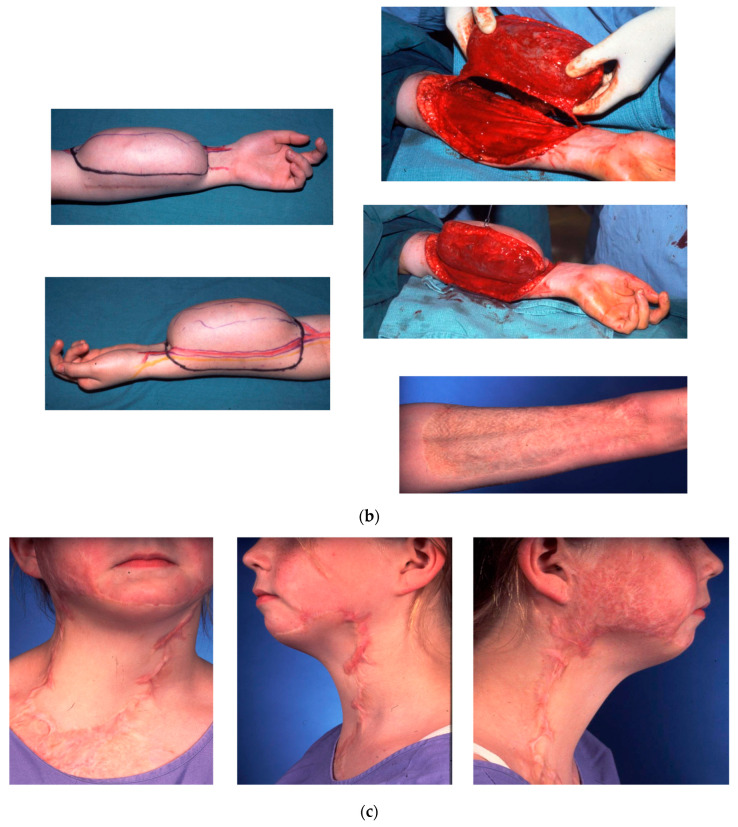Free Tissue Transfer in the Reconstruction of Neck Contractures after Burn Injury: A Case Series.