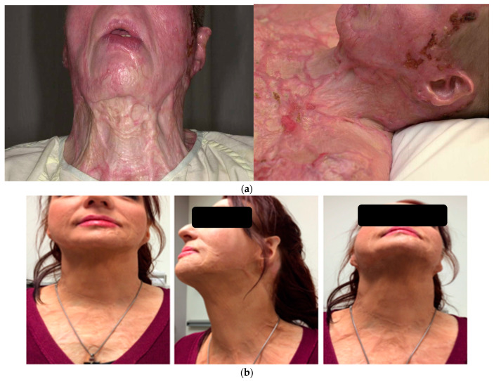 Free Tissue Transfer in the Reconstruction of Neck Contractures after Burn Injury: A Case Series.