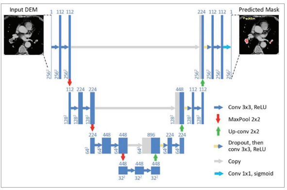 [Segmentation of acute pulmonary embolism in computed tomography pulmonary angiography using the deep learning method].