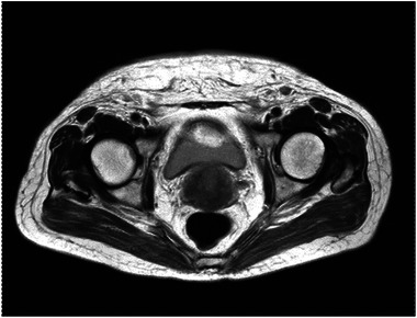 Skin metastasis in squamous cell cancer of cervix: A case report.
