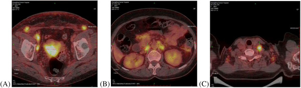 Skin metastasis in squamous cell cancer of cervix: A case report.
