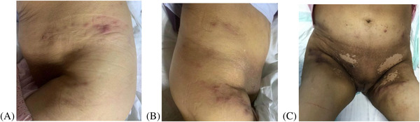 Skin metastasis in squamous cell cancer of cervix: A case report.