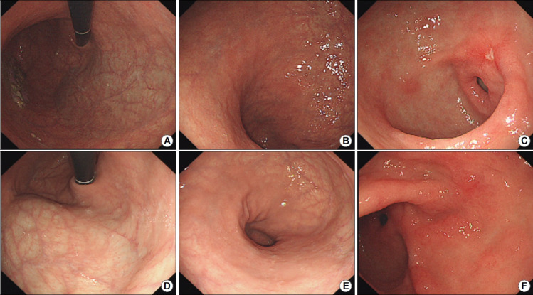 [Type A, Type B, and Non-atrophic Gastritis].