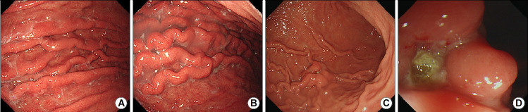[Endoscopic Findings of Common Gastritis in Koreans].