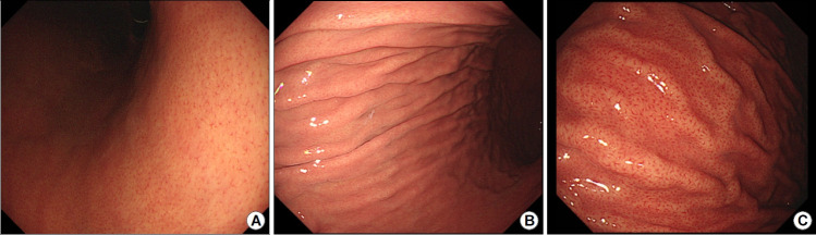 [Endoscopic Findings of Common Gastritis in Koreans].