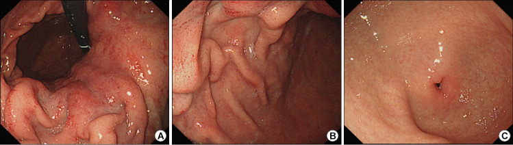 [Type A, Type B, and Non-atrophic Gastritis].
