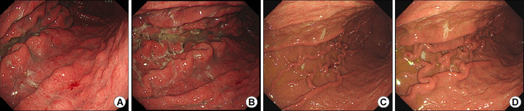 [Endoscopic Findings of Common Gastritis in Koreans].