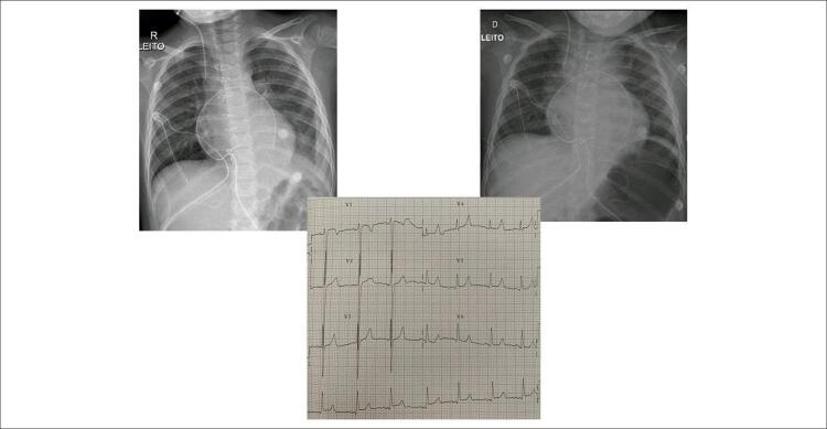 Marked Concentric Myocardial Hypertrophy with Good Postoperative Evolution in a 4 Years Old Child.