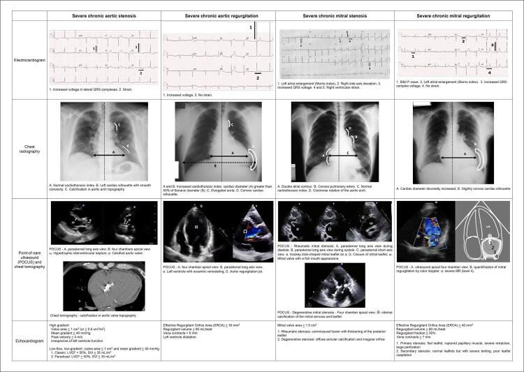 Valvular Heart Disease Emergencies: A Comprehensive Review Focusing on the Initial Approach in the Emergency Department.