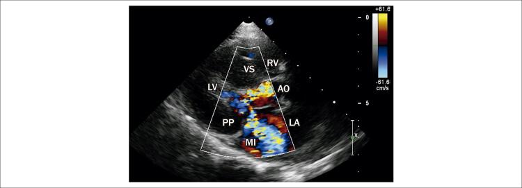 Marked Concentric Myocardial Hypertrophy with Good Postoperative Evolution in a 4 Years Old Child.