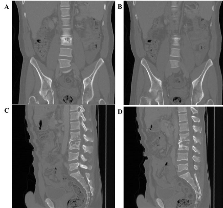 The great pretender: Multi-system tuberculosis and pathological fracture masquerading as a severe acute football groin injury - Case study with a 5-year follow-up.