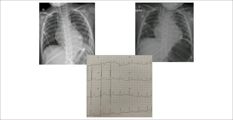 Marked Concentric Myocardial Hypertrophy with Good Postoperative Evolution in a 4 Years Old Child.