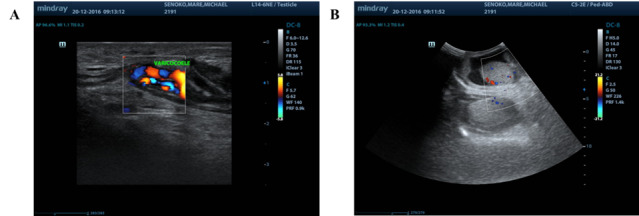 The great pretender: Multi-system tuberculosis and pathological fracture masquerading as a severe acute football groin injury - Case study with a 5-year follow-up.
