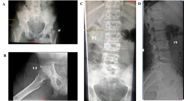The great pretender: Multi-system tuberculosis and pathological fracture masquerading as a severe acute football groin injury - Case study with a 5-year follow-up.