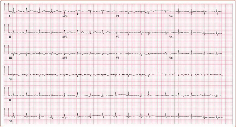 A Case of Primary Cardiac B-cell Lymphoma Diagnosed with Cardiac MRI.