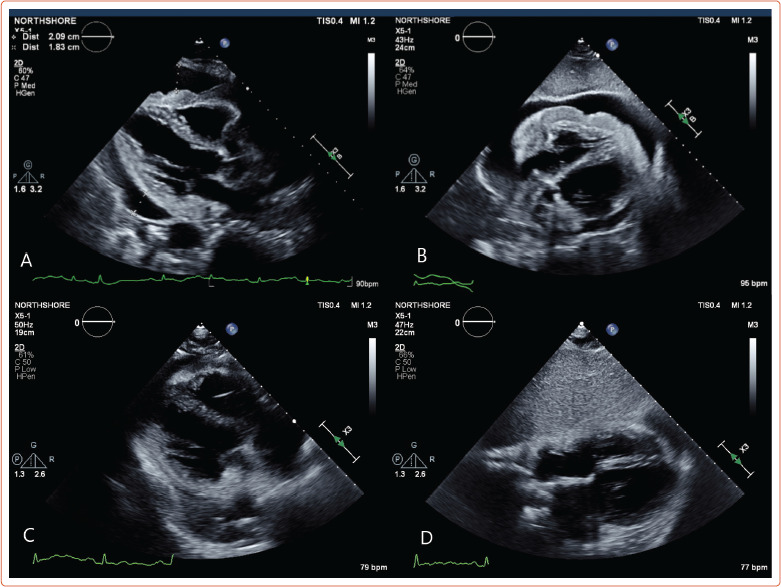 A Case of Primary Cardiac B-cell Lymphoma Diagnosed with Cardiac MRI.