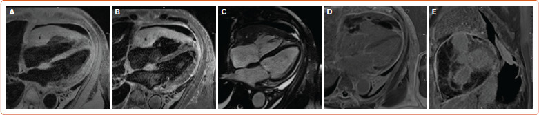A Case of Primary Cardiac B-cell Lymphoma Diagnosed with Cardiac MRI.