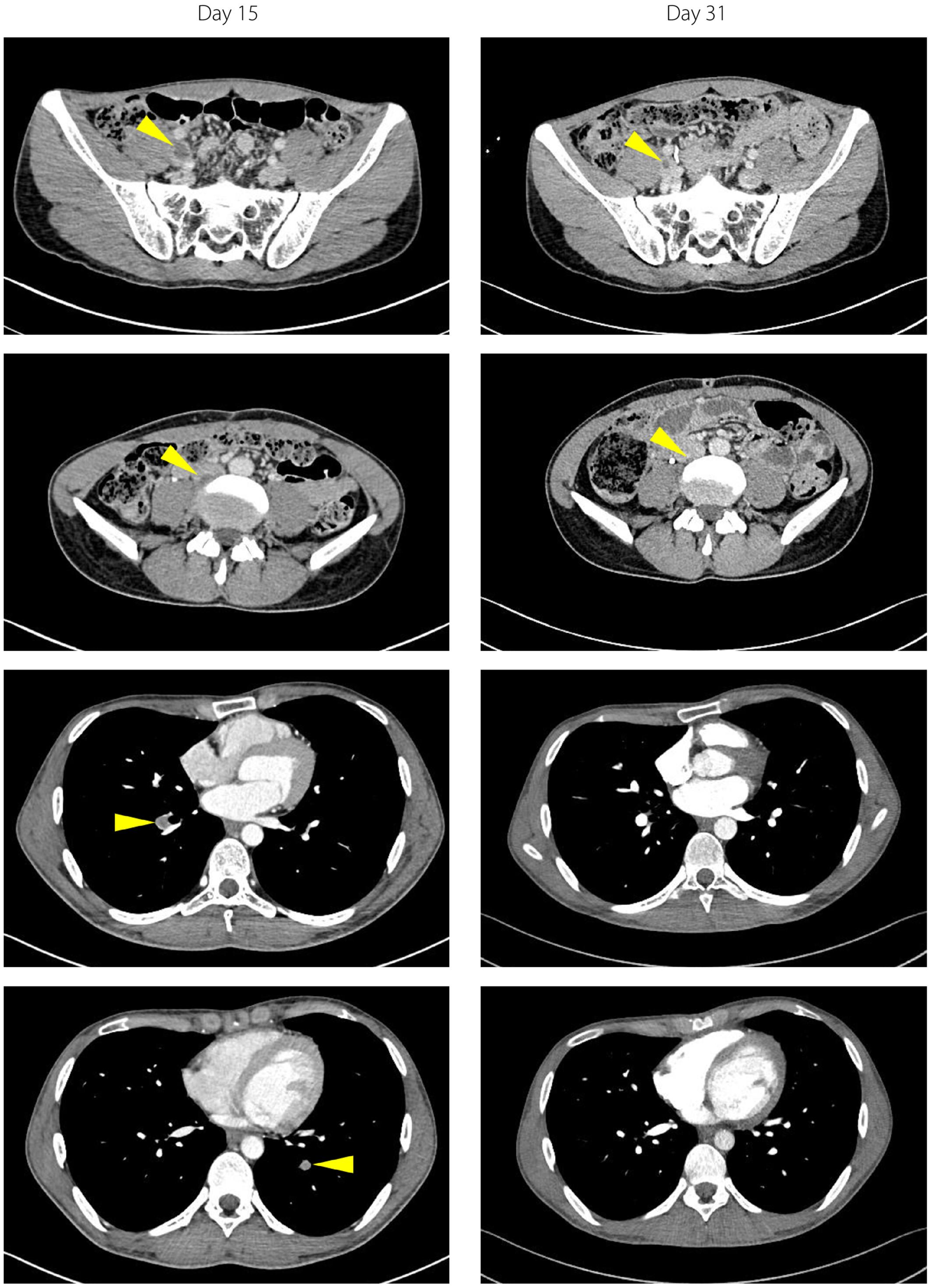 A case of fulminant type 1 diabetes and protein C deficiency complicated by deep vein thrombosis