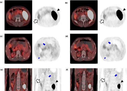 Noninvasive evaluation of donor and native pancreases following simultaneous pancreas–kidney transplantation using positron emission tomography/computed tomography