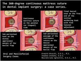 The 360-degree continuous mattress suture in dental implant surgery: A case series