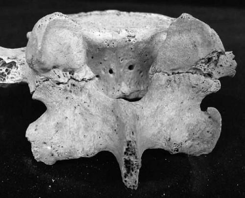 Spondylolysis in ancient Nubian skeletal populations