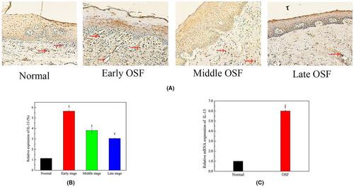 Interleukin-13 contributes to the occurrence of oral submucosal fibrosis