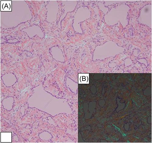 Amyloid goiter secondary to familial Mediterranean fever with E148Q mutation: A unique case