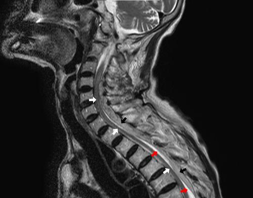 Three layers in spinal canal