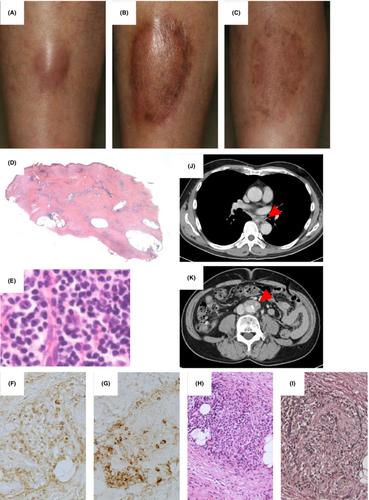 A case of IgG4-related skin disease with plaques on the lower legs